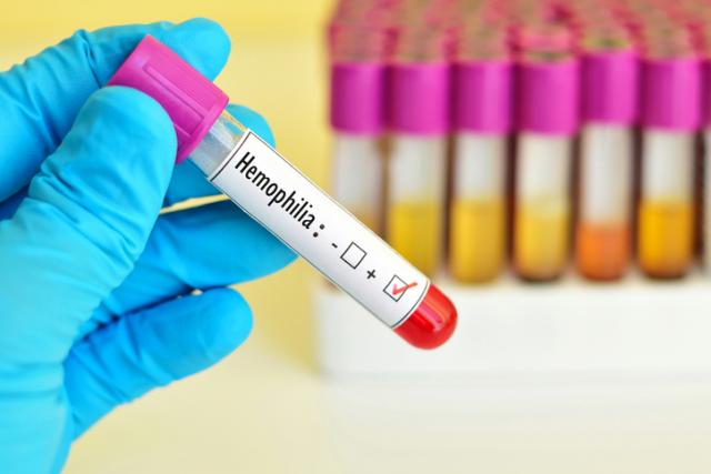U Srbiji oko 120 dece živi s hemofilijom